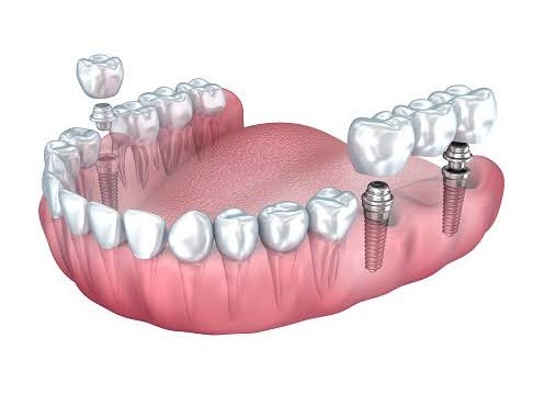 Multiple Teeth Implants