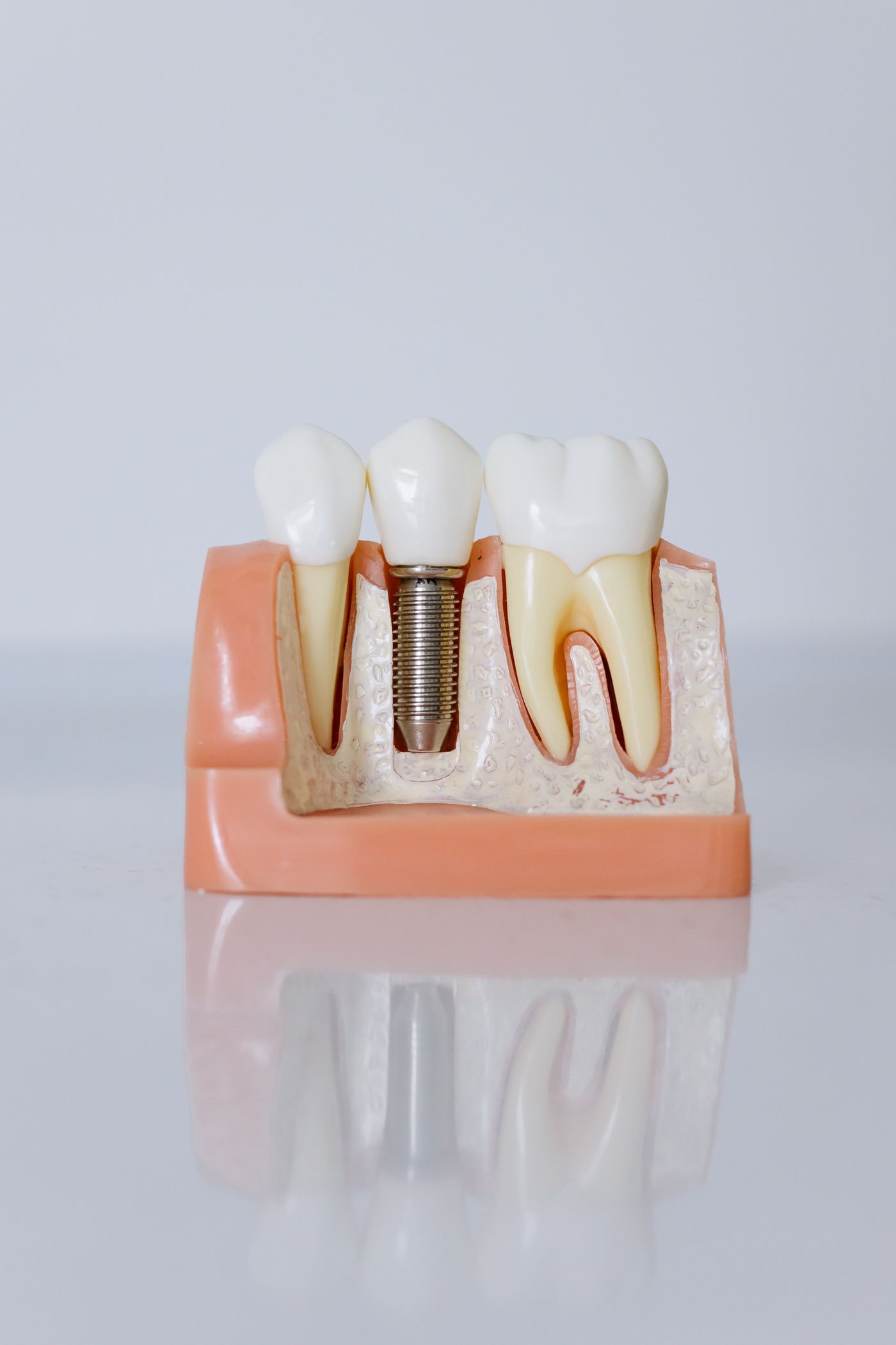 Implant Dentistry at JP Dental, Perambur